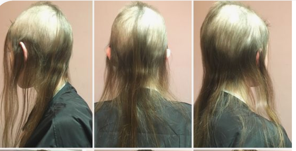 Coping With Trichotillomania During Covid-19 Isolation