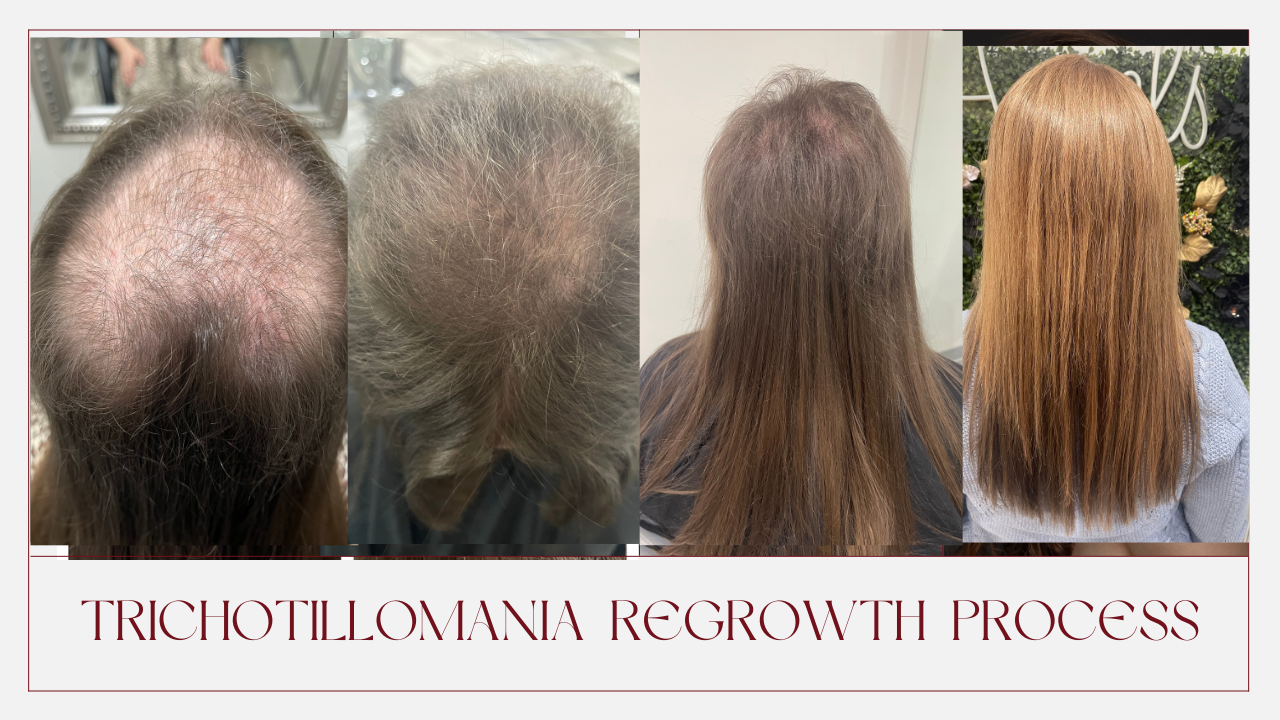 Trichotillomania Regrowth Strategies Boston, MA