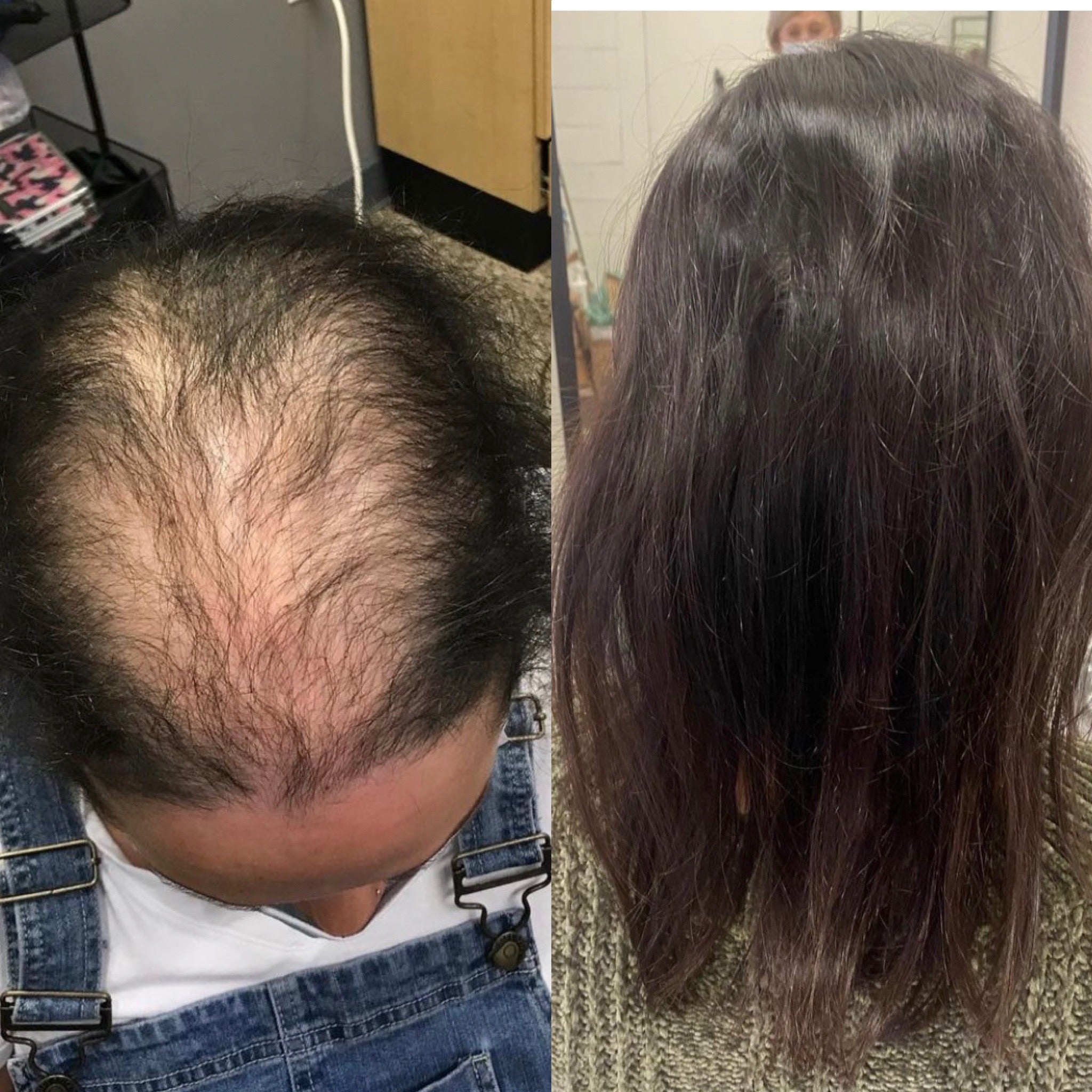 What is trichotillomania?