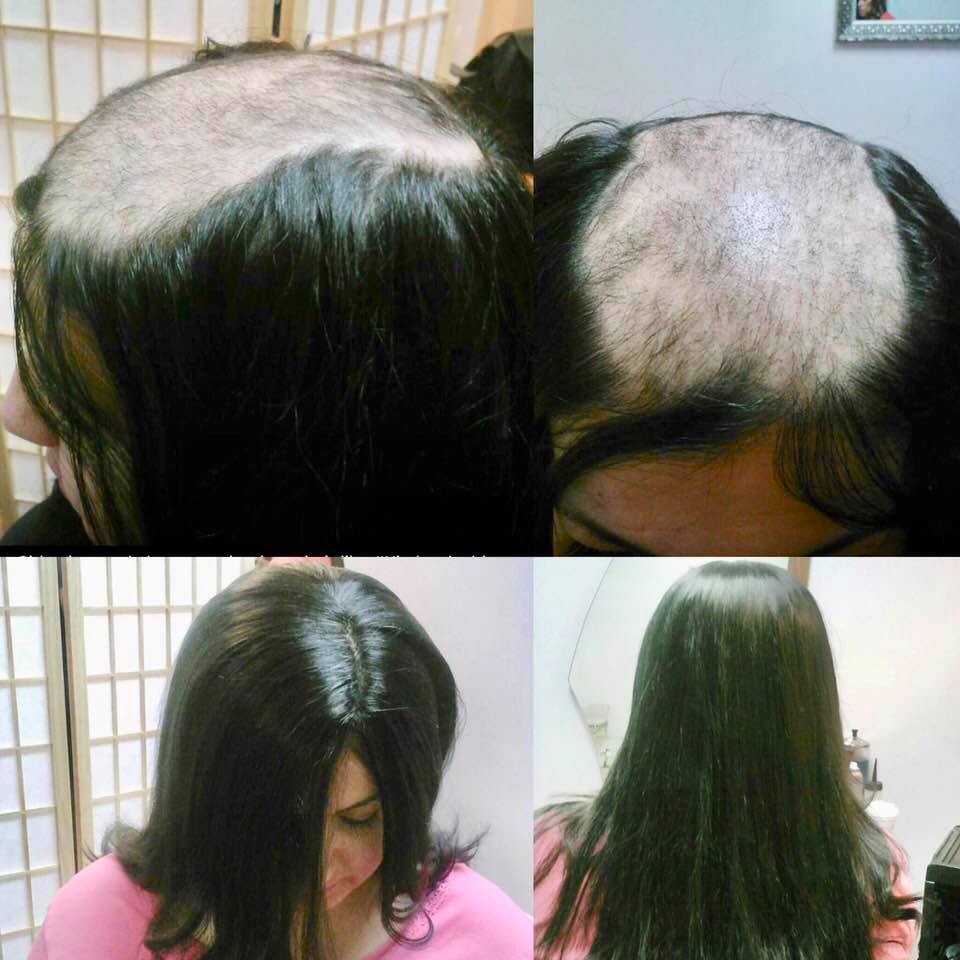 trichotillomania help