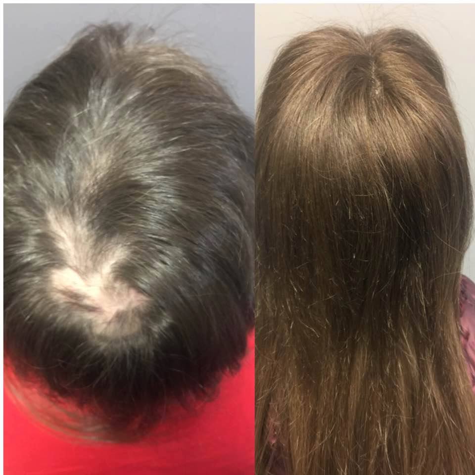 regrowth from lupus alopecia