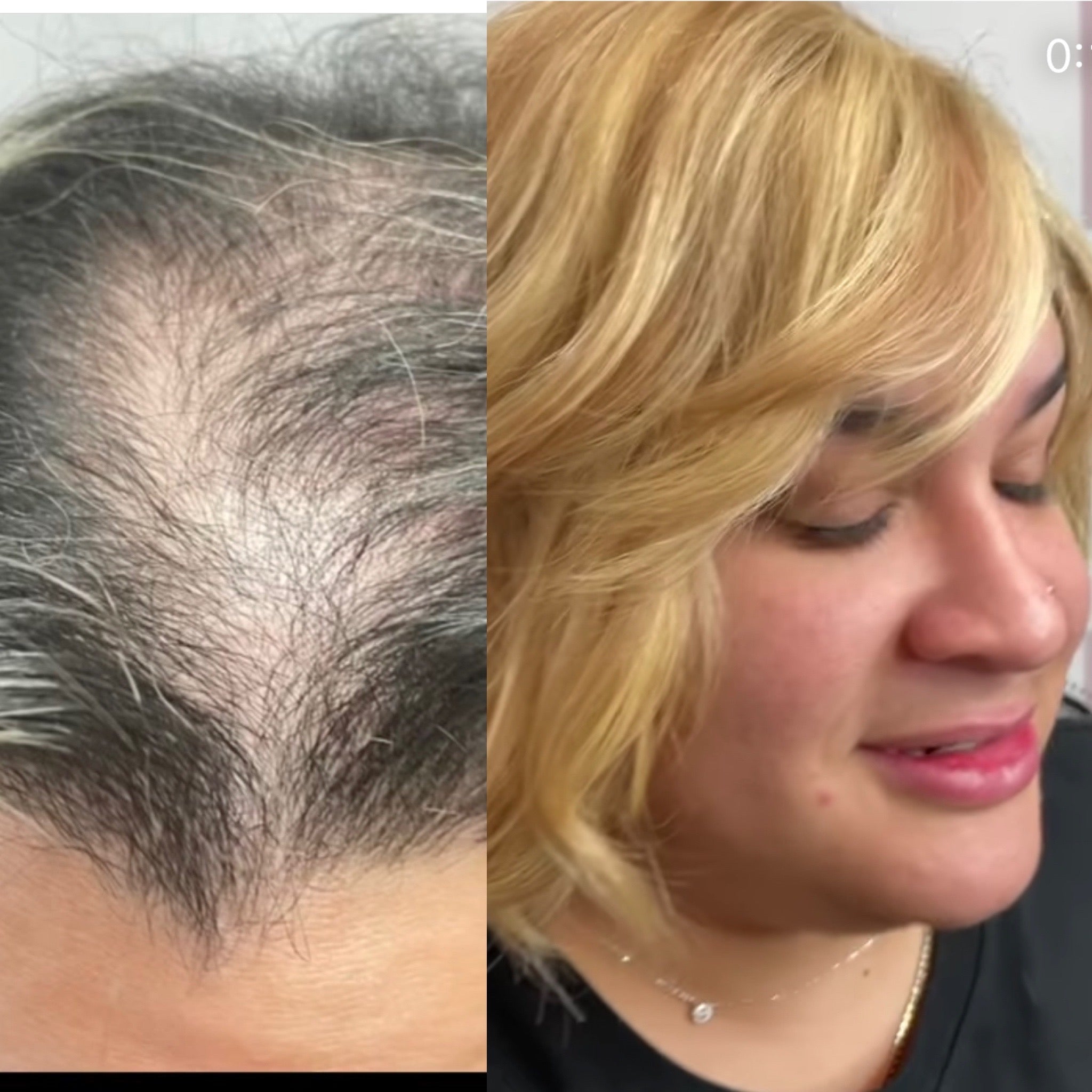 Hair Thinning In women
