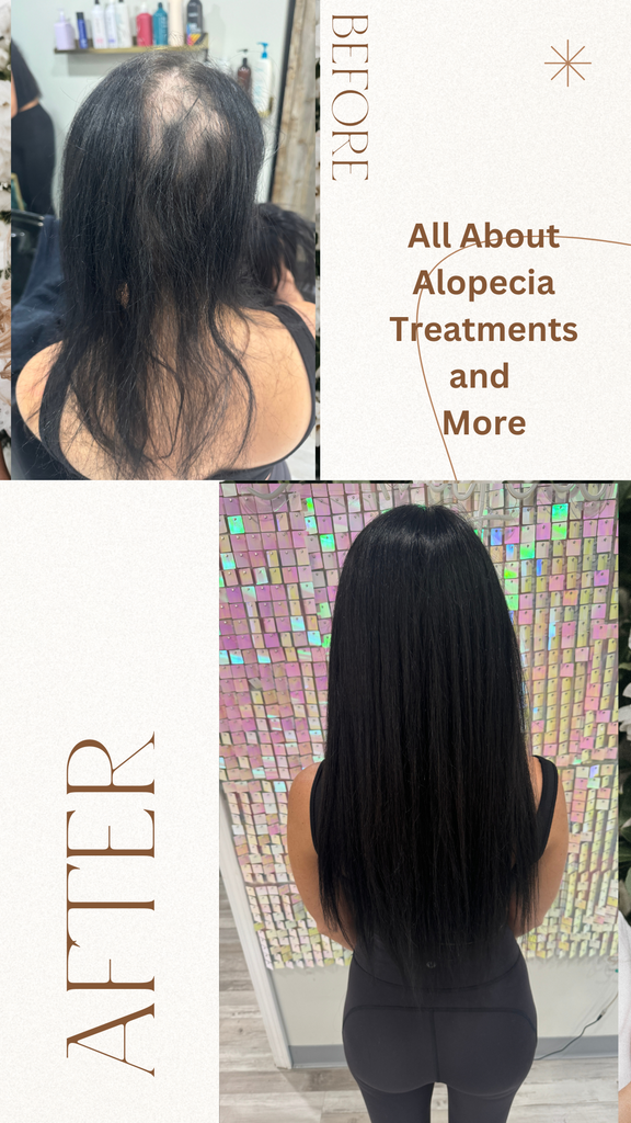 Alopecia Areata: Causes, Symptoms, & Olumiant Treatment Key Highlights Alopecia areata is an autoimmune 