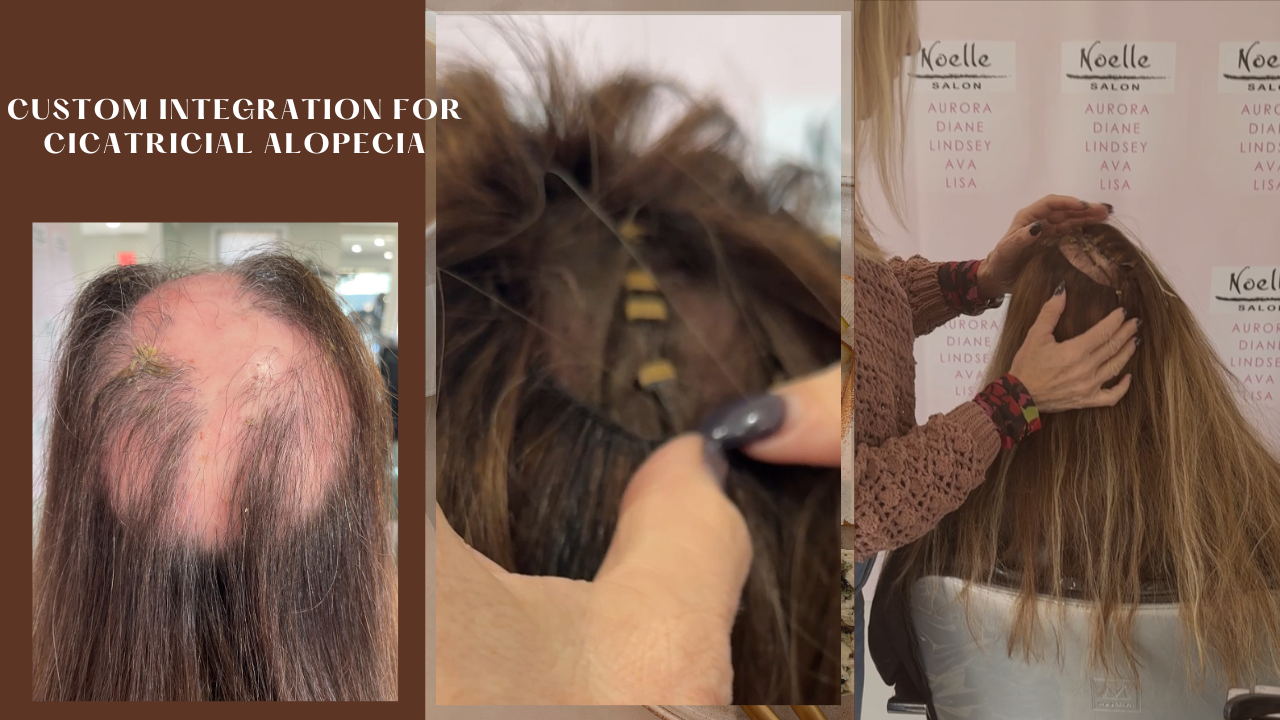 Mesh integration for cicatricial alopecia