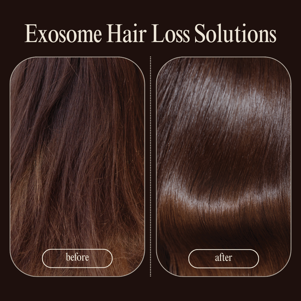 exosome hair loss Boston