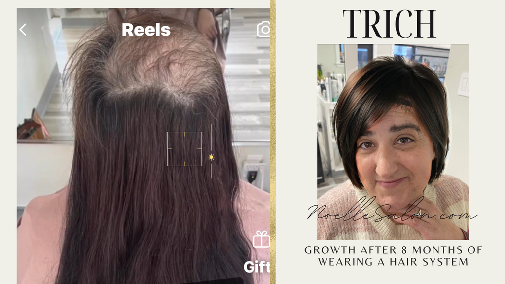 Trichotillomania Hair Regrowth: Expert Tips and Strategies Boston, Massachusetts