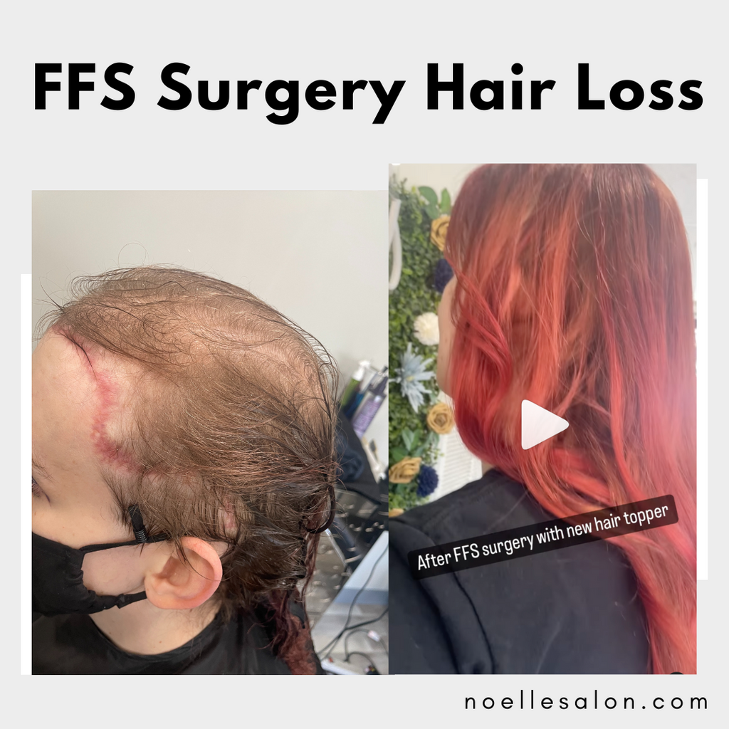 FFS Surgery hair loss