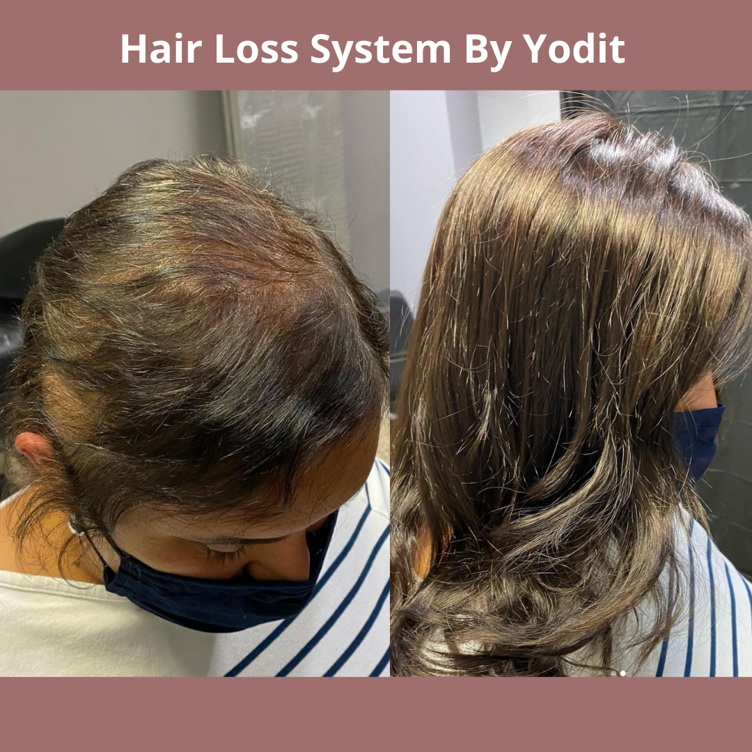 Attending College With Trichotillomania