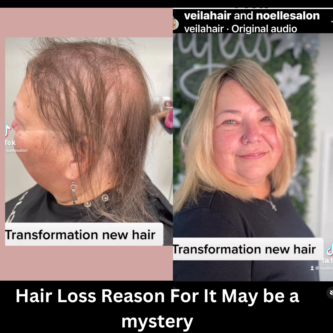 Mystery Hair Loss In Women And Long Covid