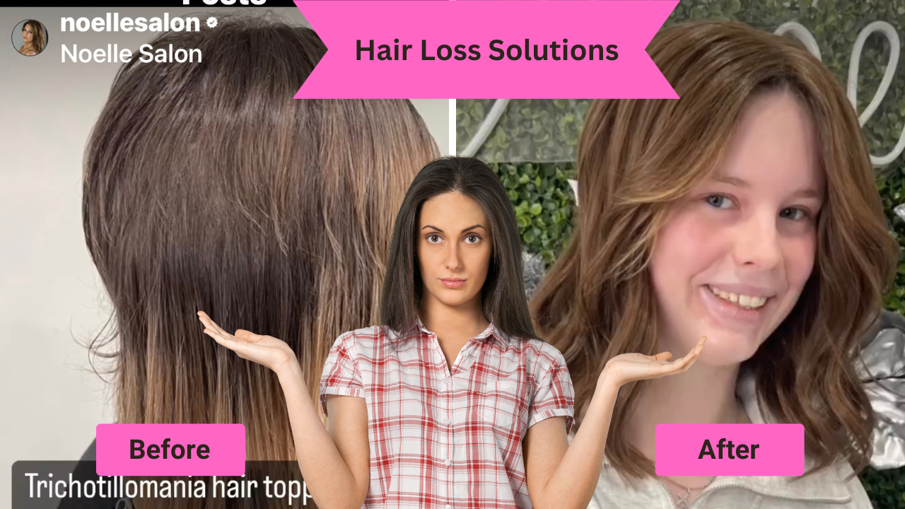  Hair Loss Before and After Boston