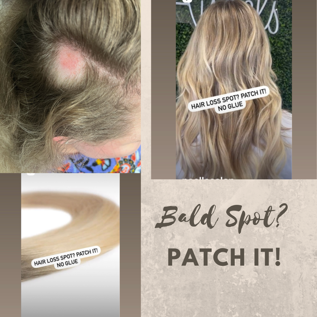 Update more than 132 hair patch treatment best