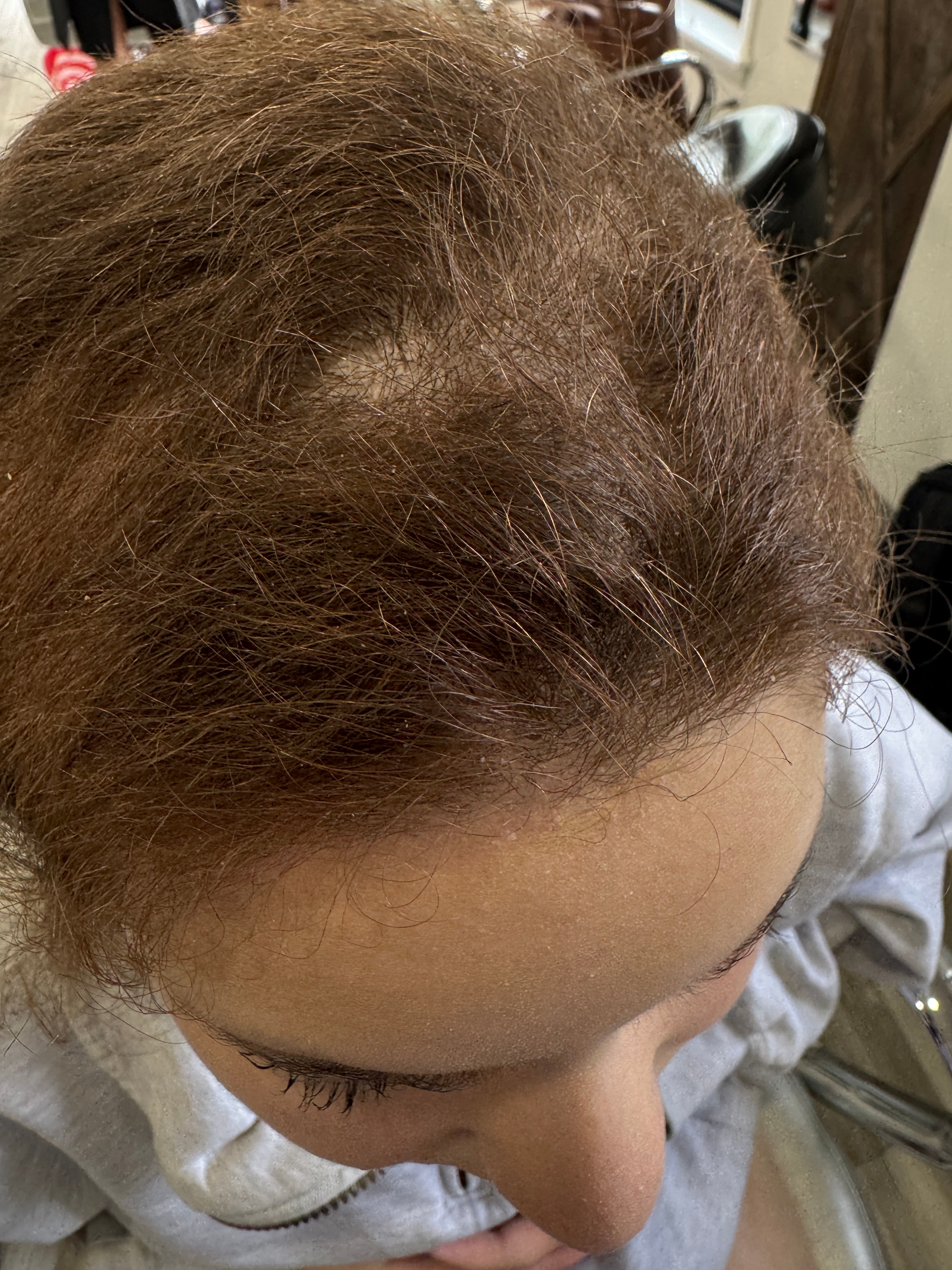 Close-up of pili torti hair breakage showing the twisted hair shaft