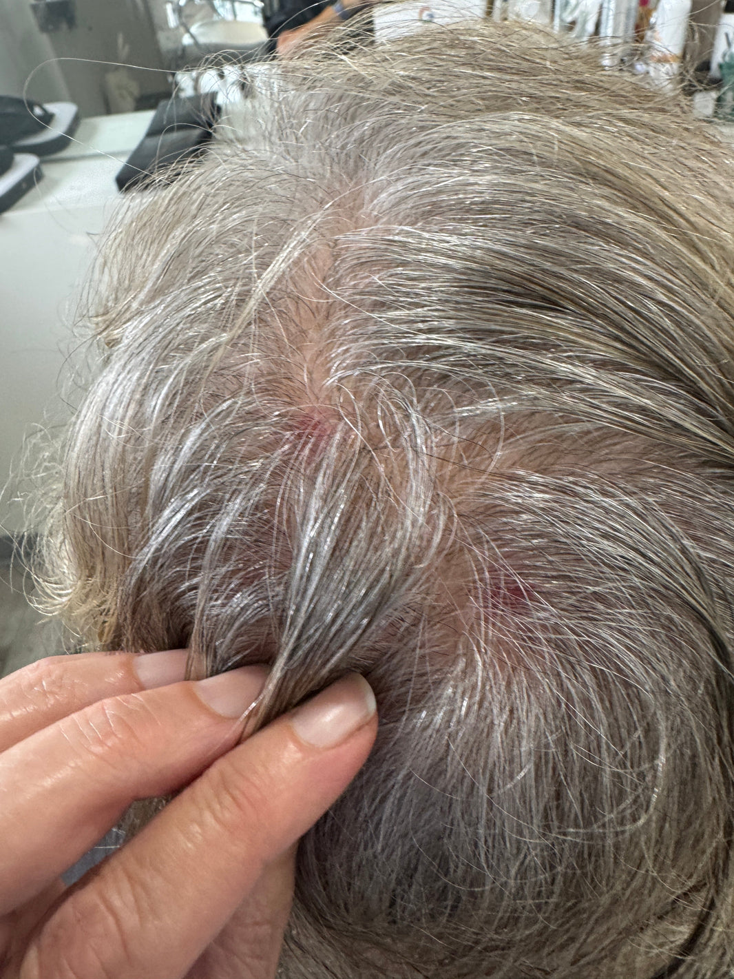 Close-up of scalp psoriasis — a condition we always recommend a dermatologist evaluate before any cosmetic hair service