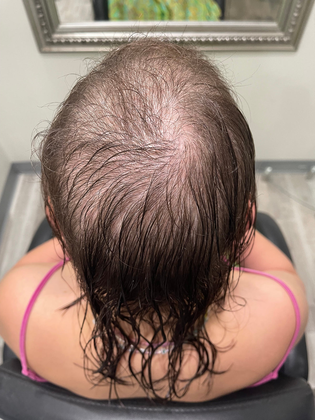 a woman with alopecia