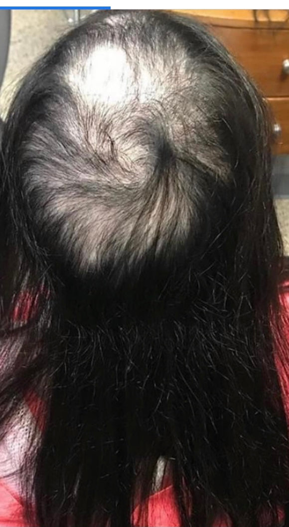 hair loss due to covid
