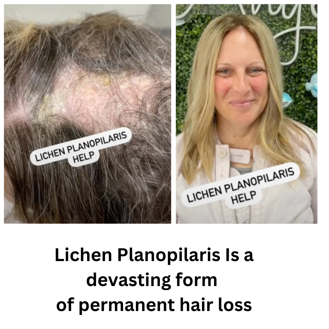 Lichen Planopilaris hair loss solution