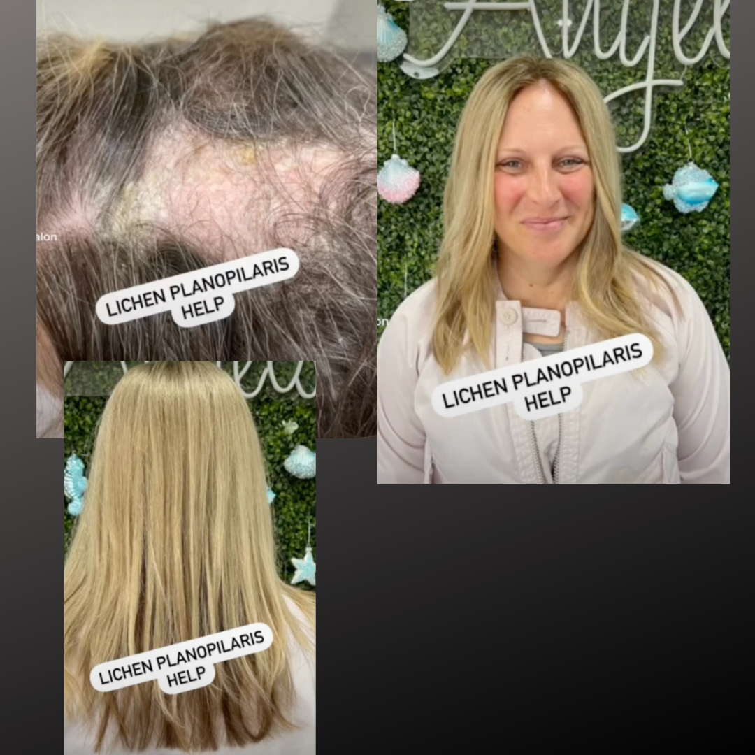 Hair Loss - Help In Treating Lichen Planopilaris – noellesalon