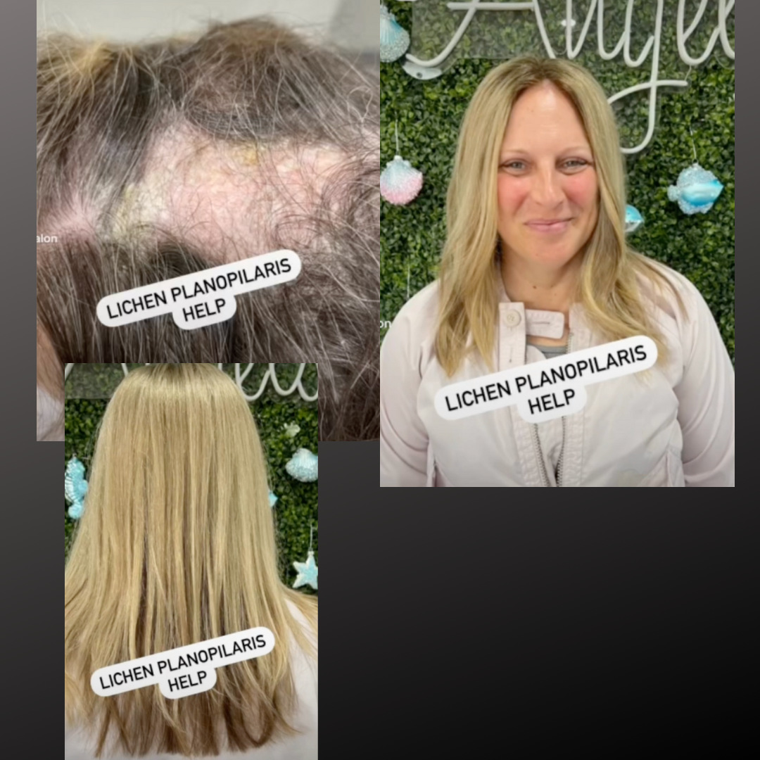 Lichen Planopilaris hair loss