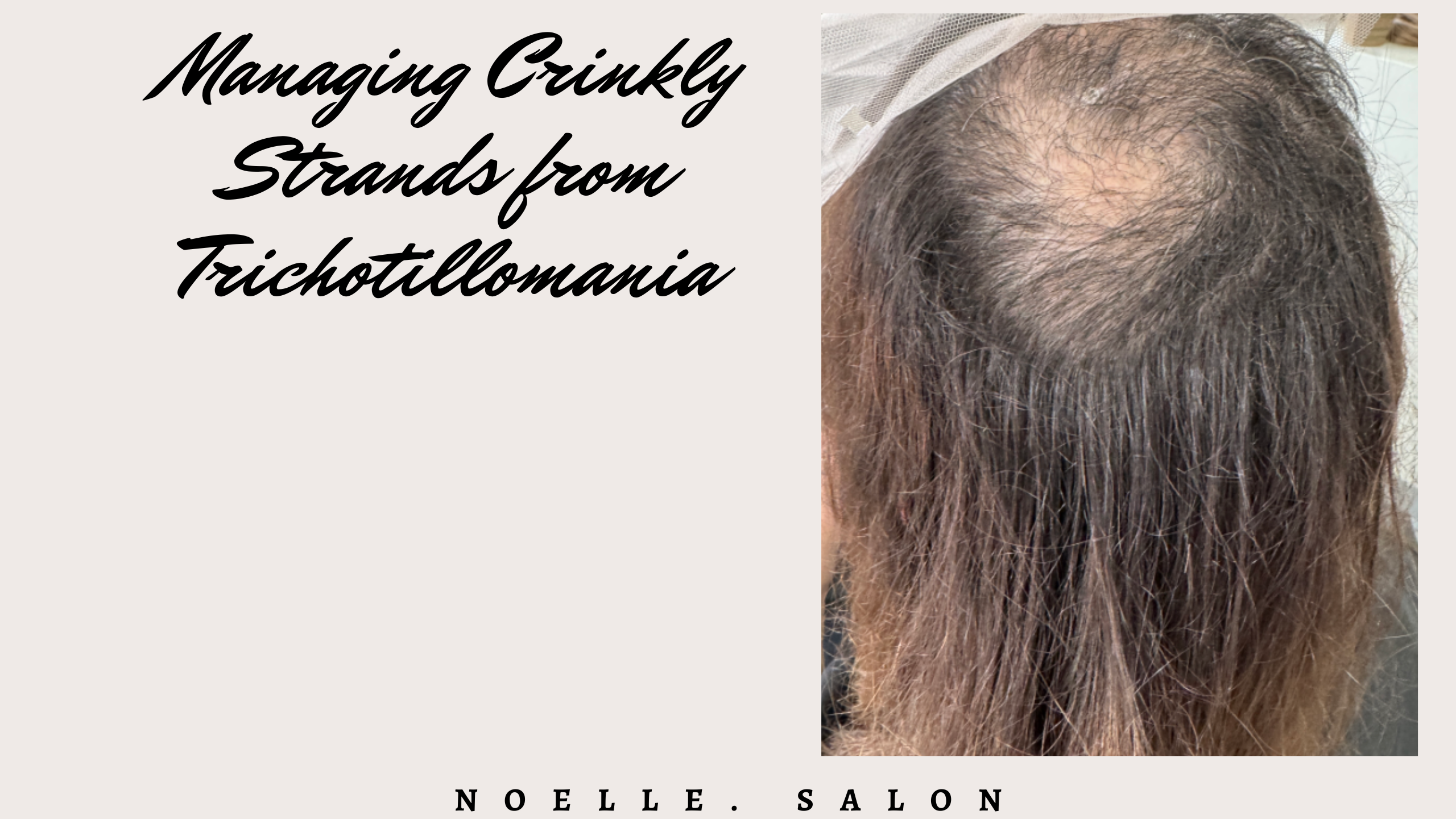 Managing Trichotillomania