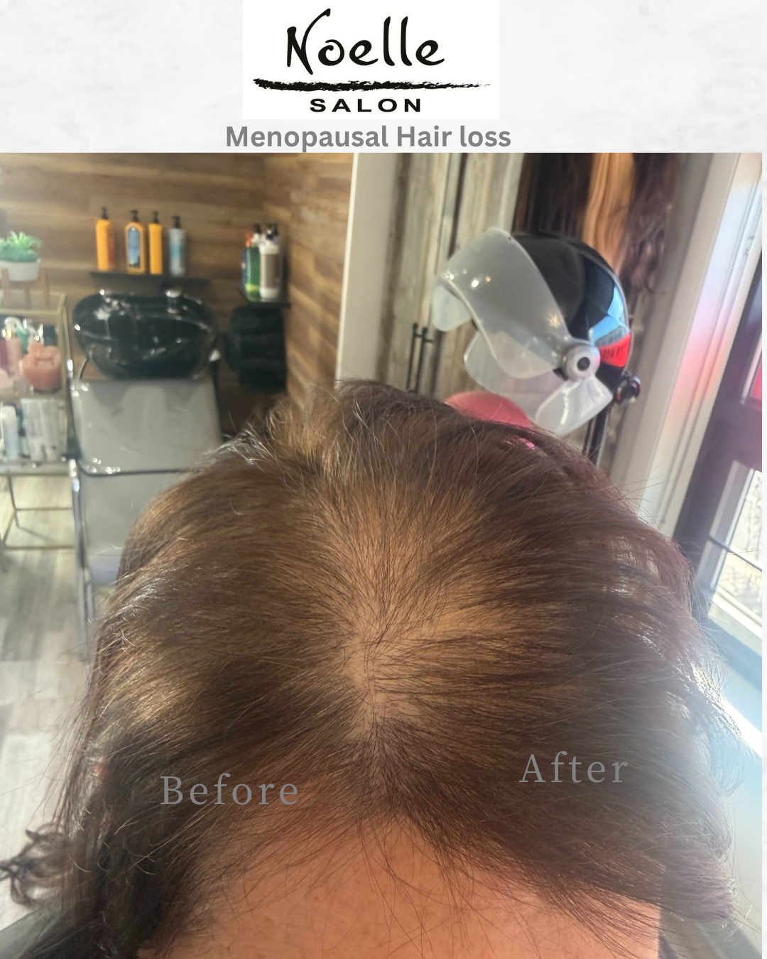 Menopausal hair loss causing thinning at the crown and widening part line in women over 50