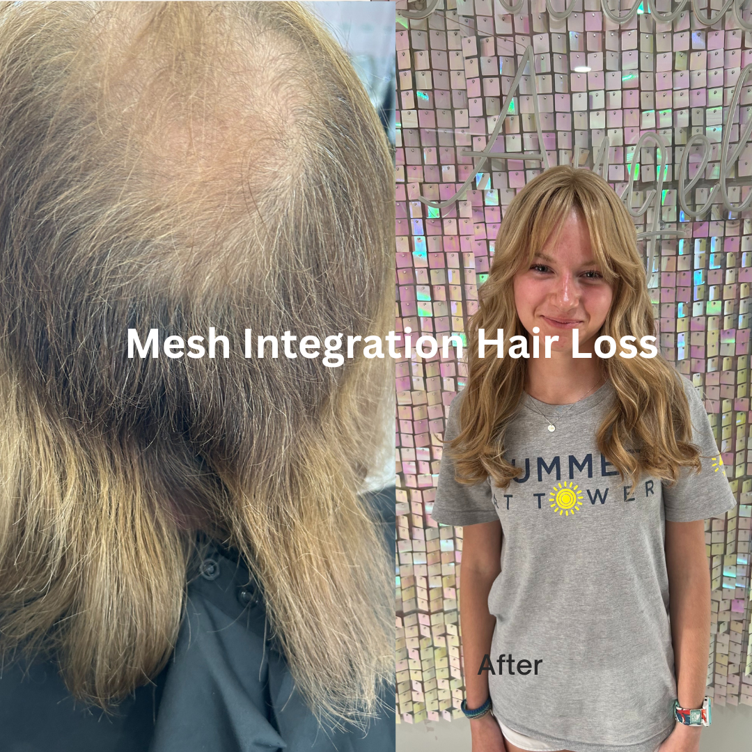 Hair Loss Salon Boston