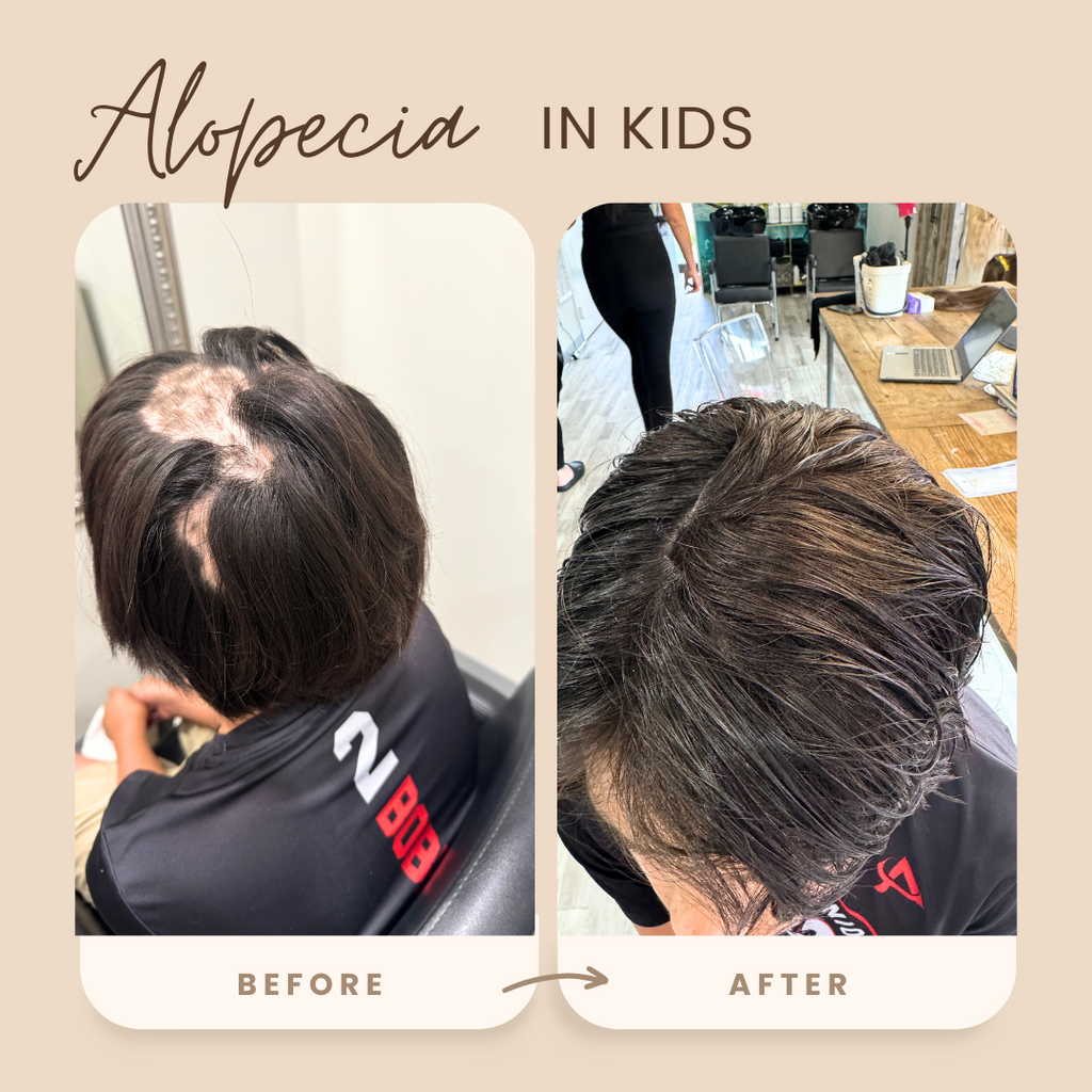 Alopecia Areata Children