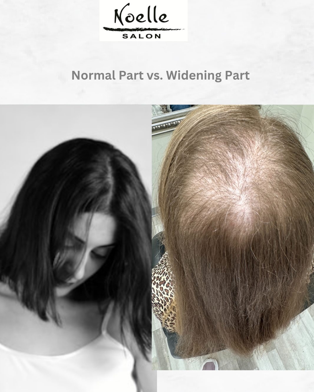 Early female pattern hair loss showing a normal part compared to a widening part