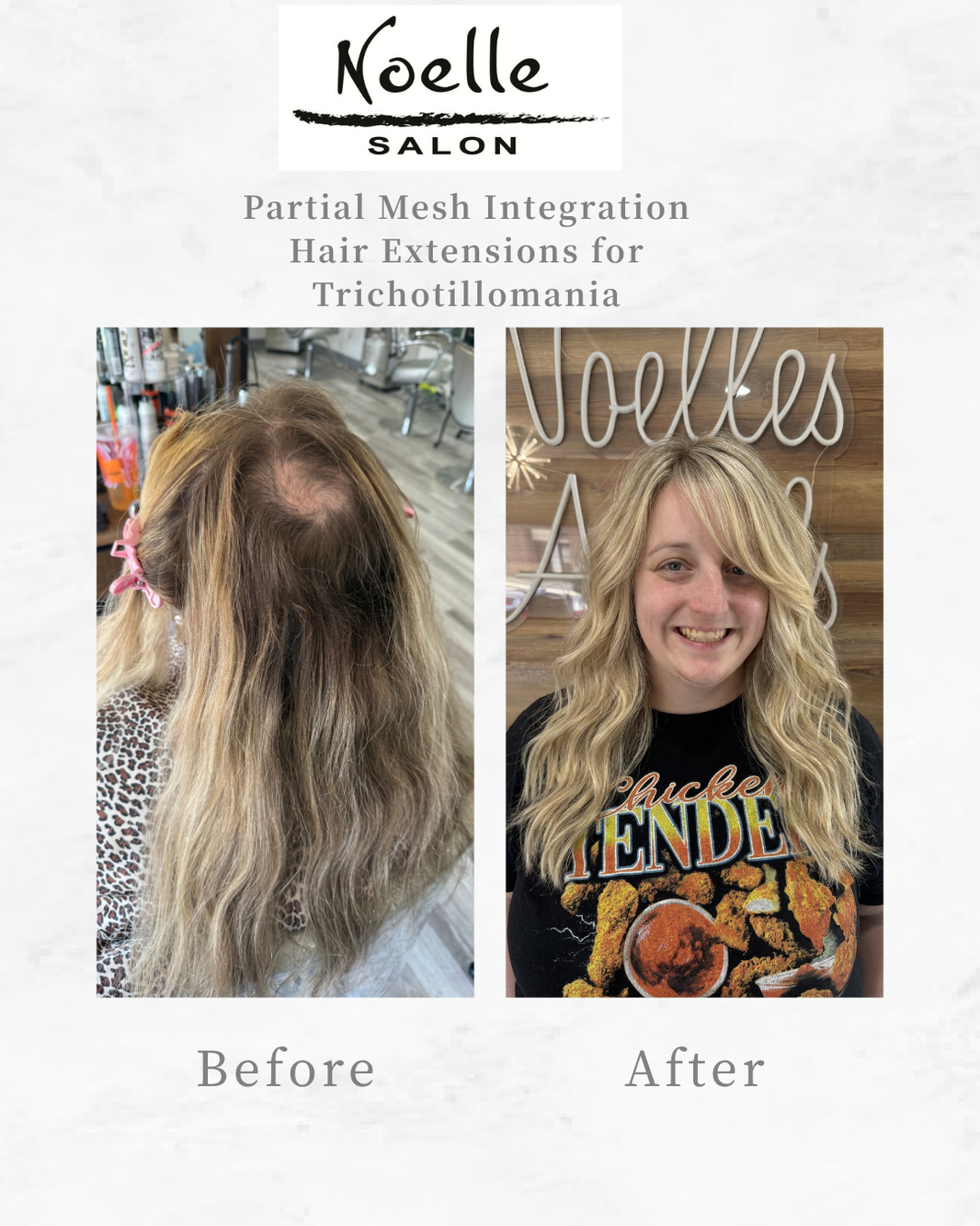 Partial mesh integration hair extensions for trichotillomania hair loss creating natural-looking coverage and restored fullness.