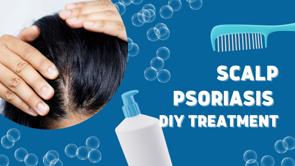 scalp psoriasis at home remedy