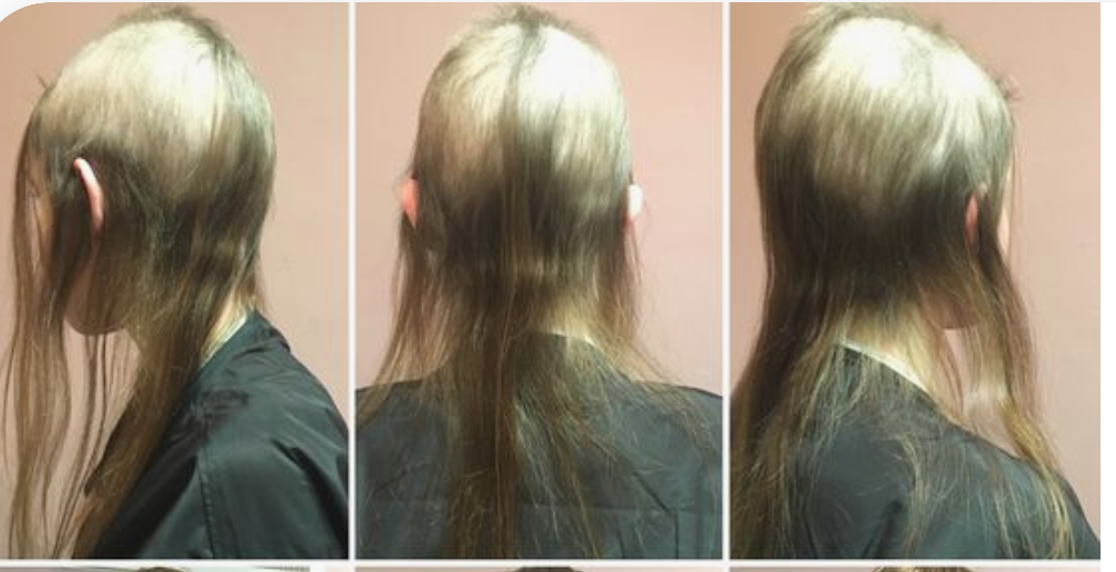 trichotillomania hair loss due ot hair pulling