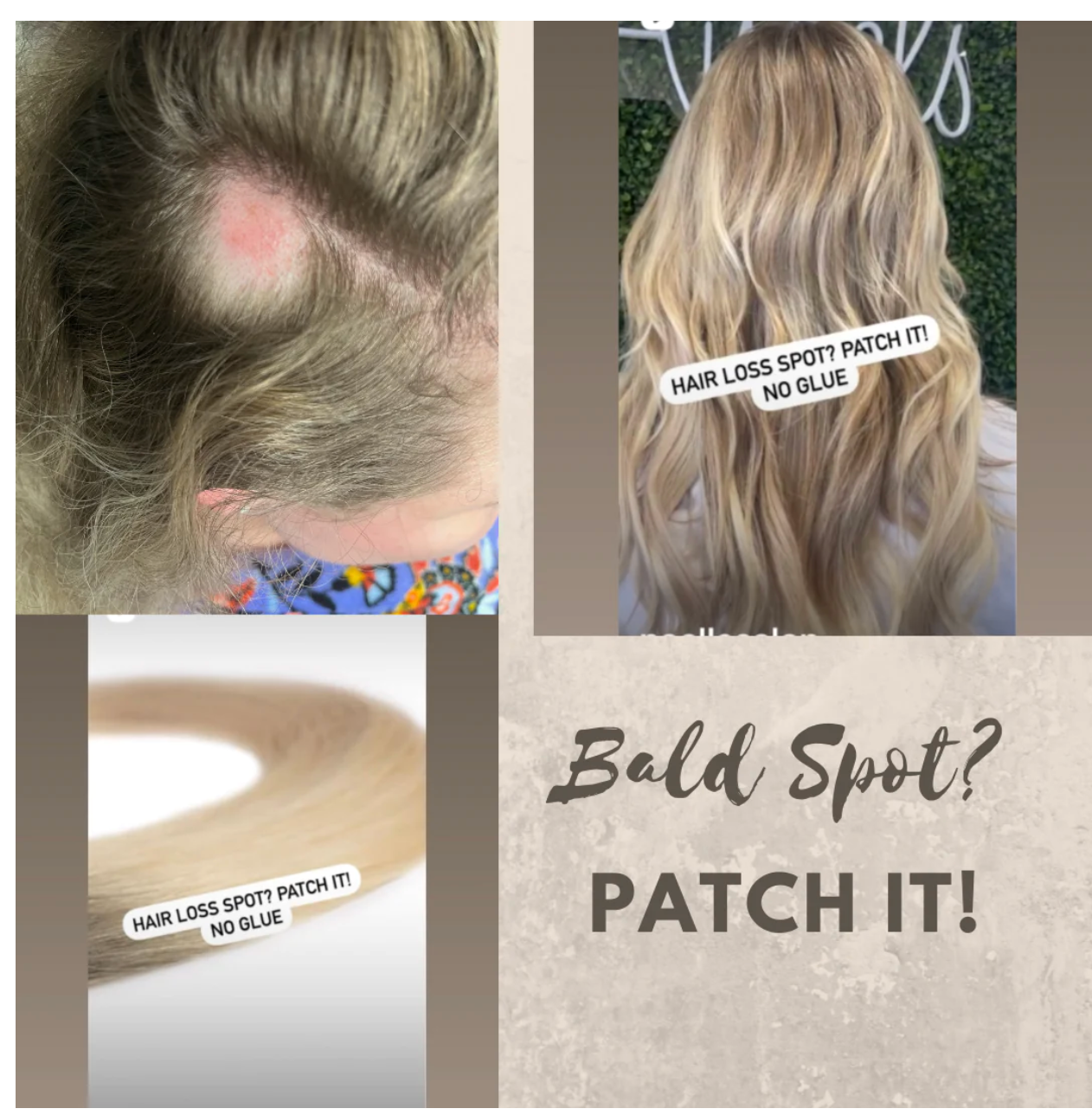 Bald spots in women