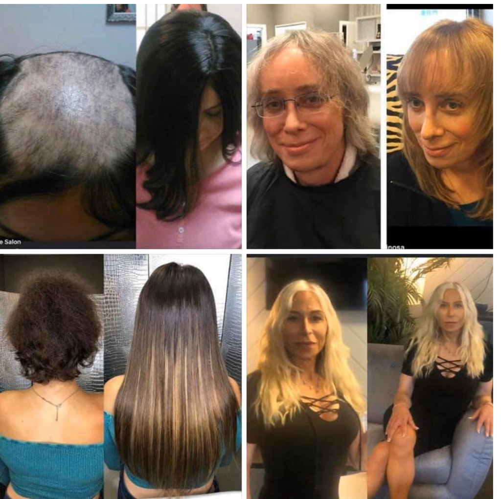 Boston Transgender Hair: FFS & Hair Loss FAQs Answered