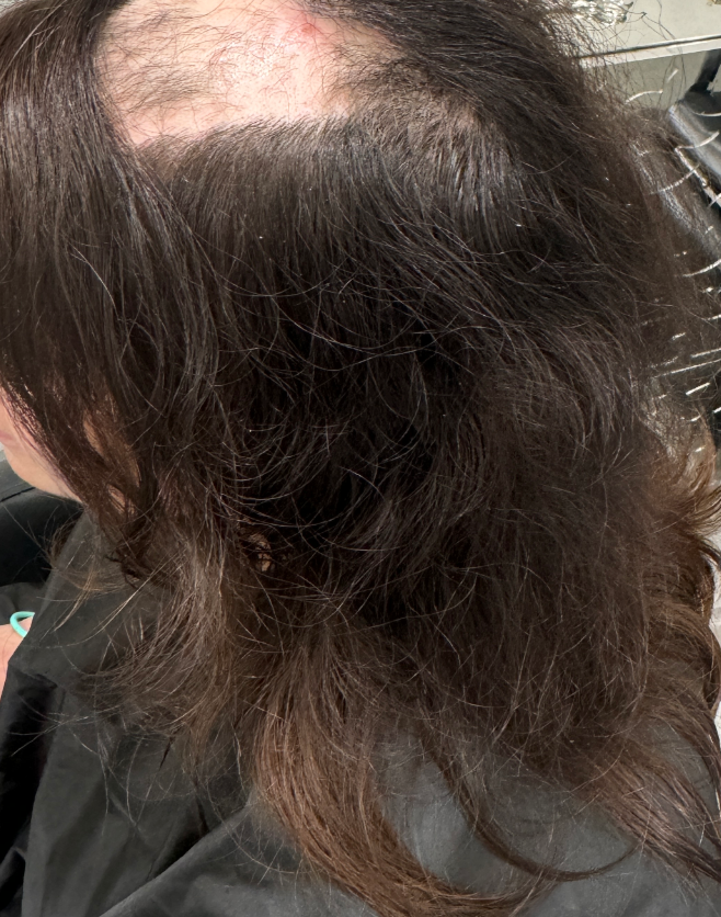how common is trichotillomania