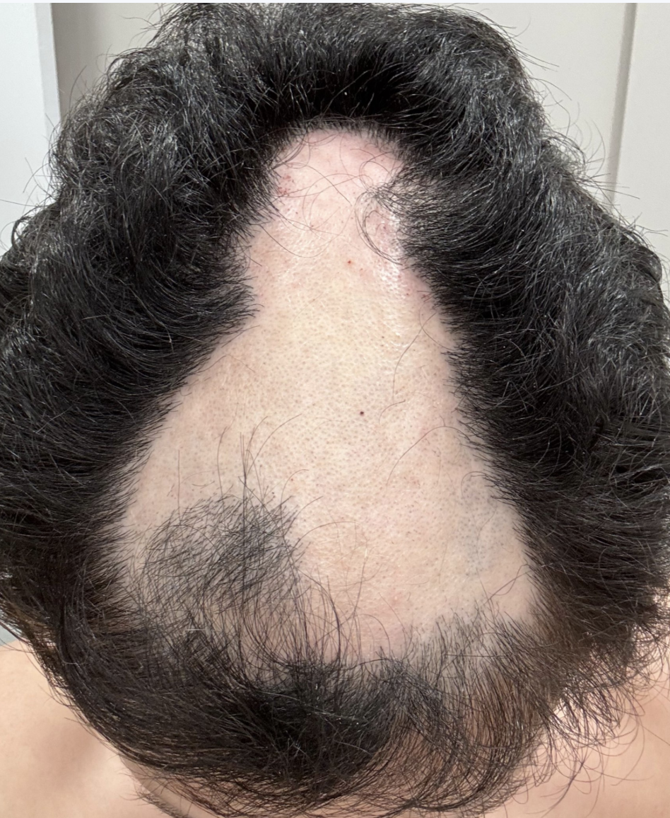 Hair extensions for Trichotillomania