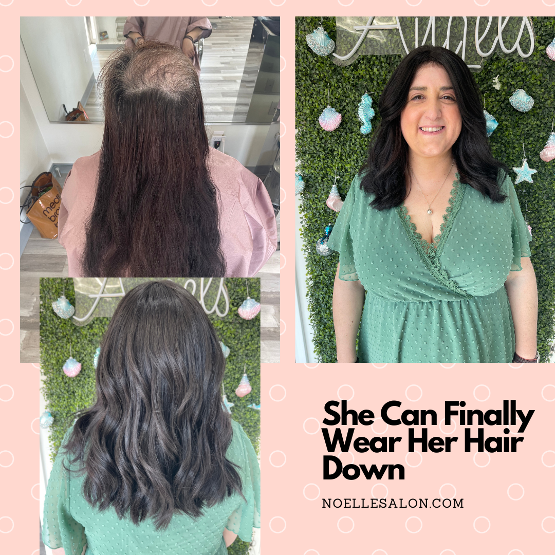 Understanding Trichotillomania In Boston
