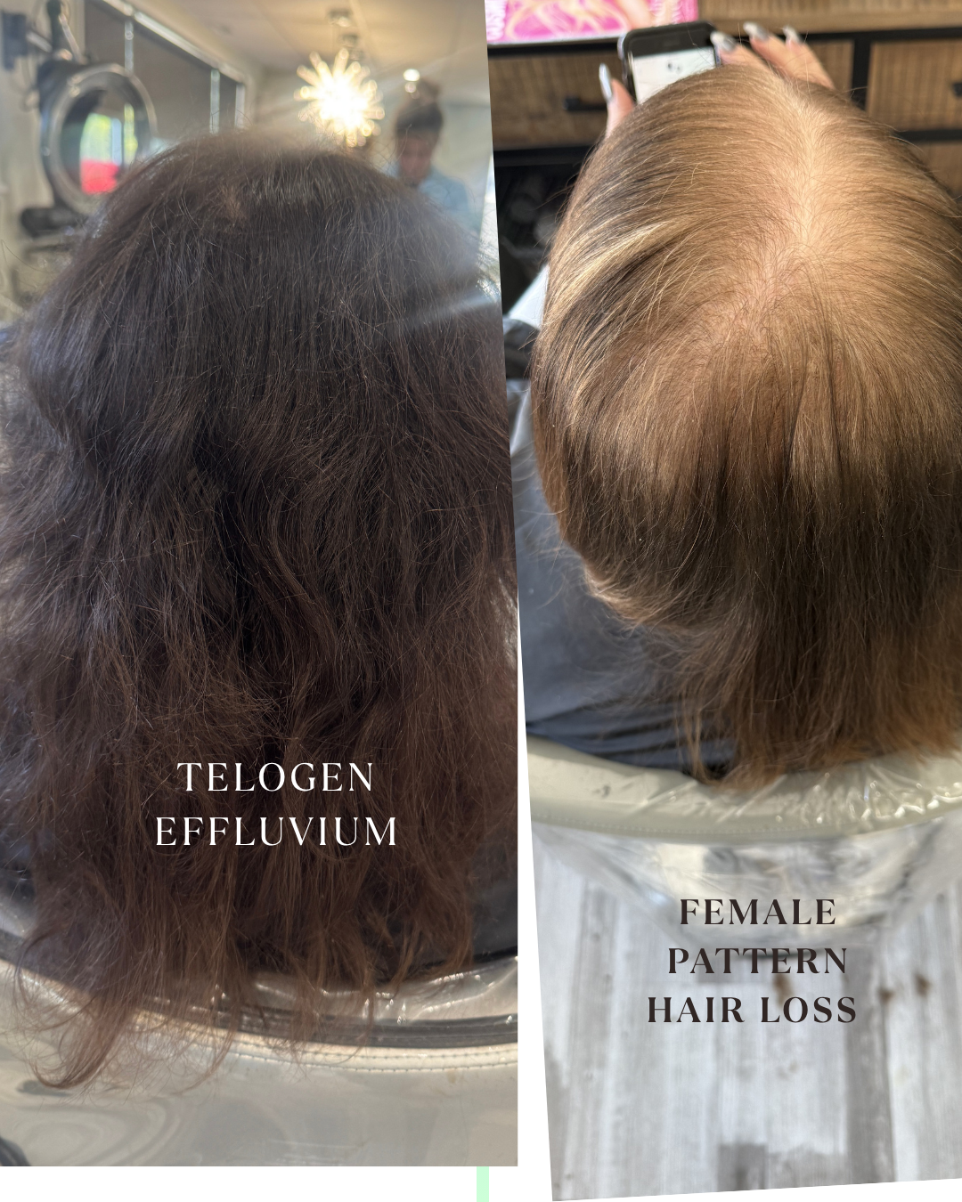 Comparison showing common visual differences between telogen effluvium shedding and female pattern hair loss thinning patterns.