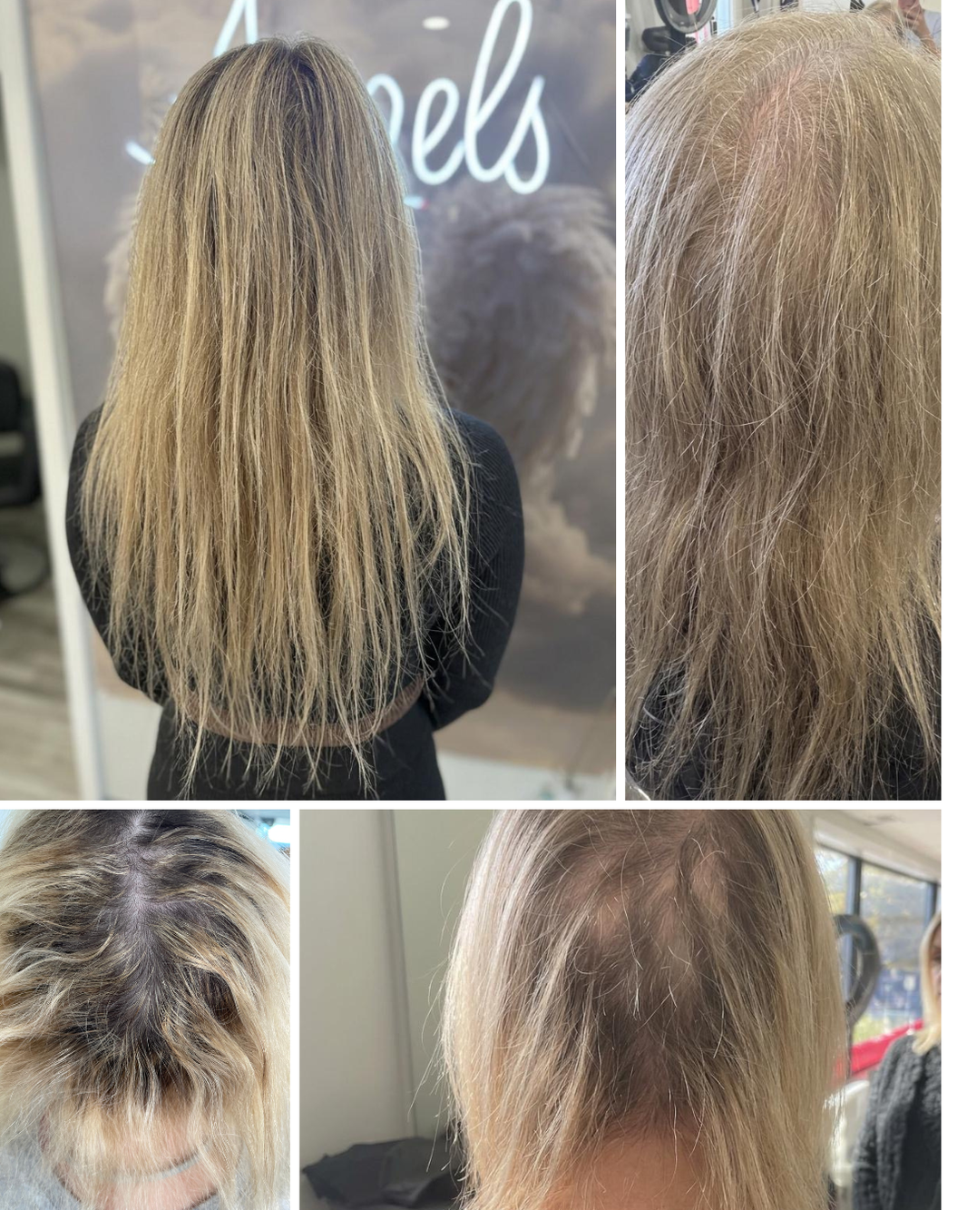 Female hair loss progression showing increased scalp visibility and crown thinning