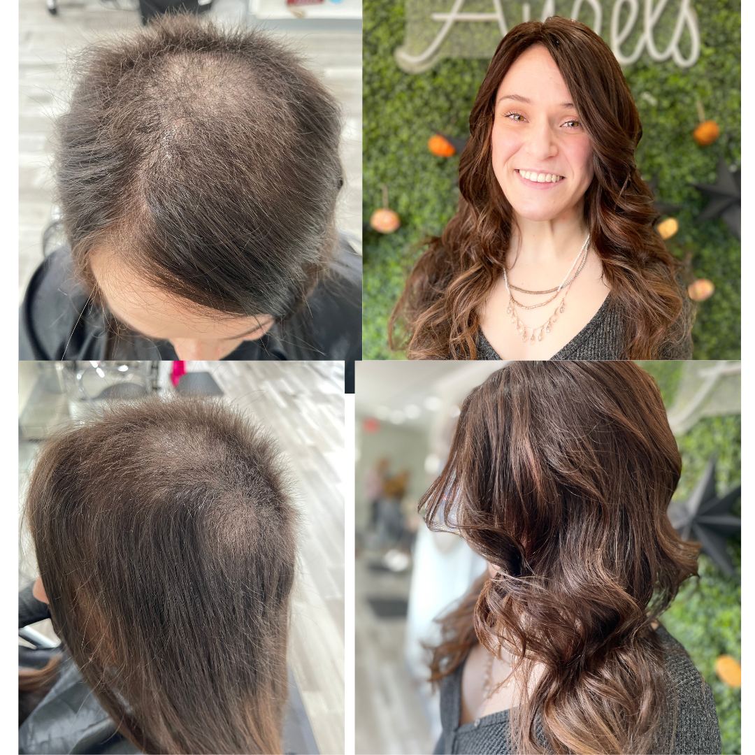 understanding trichotillomania