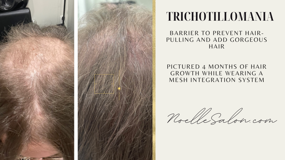 Trichotillomania Hair Regrowth Barriers Boston noellesalon
