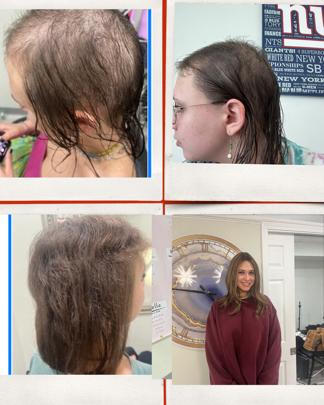 Trichotillomania recovery progression showing hair regrowth, increased density, and restored confidence after years of hair pulling.