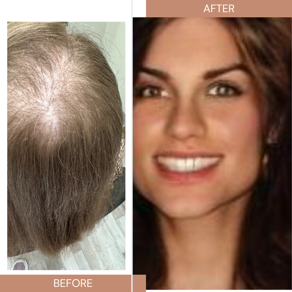 Hair Toppers for hair loss Boston