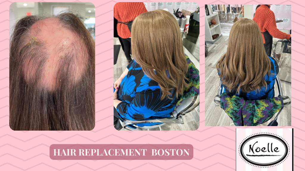 Ultimate Guide to Hair Replacement for Women in Boston, Massachusetts