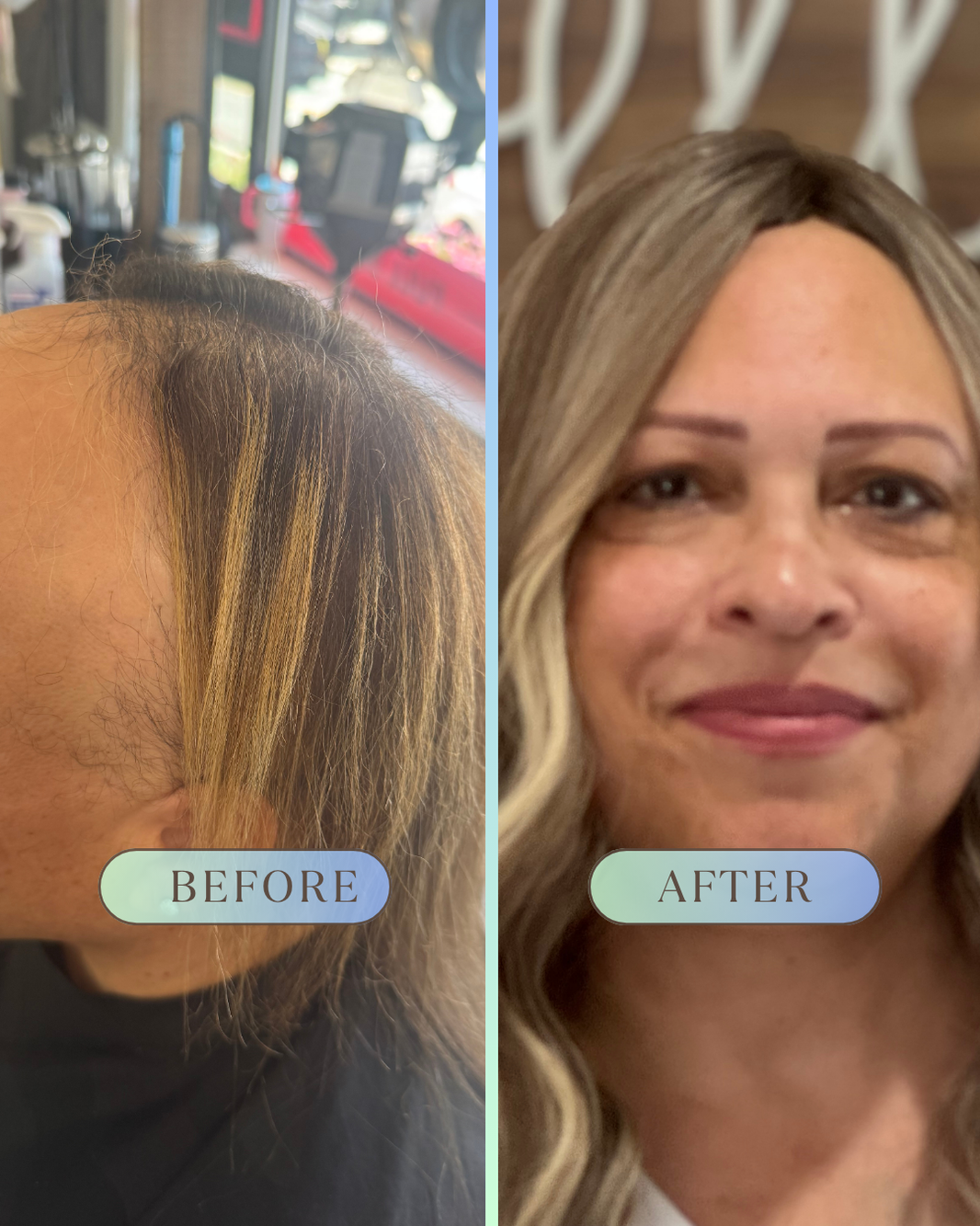 Before and after attached hair replacement for chemotherapy-related hair loss restoring a natural hairline and natural appearance.