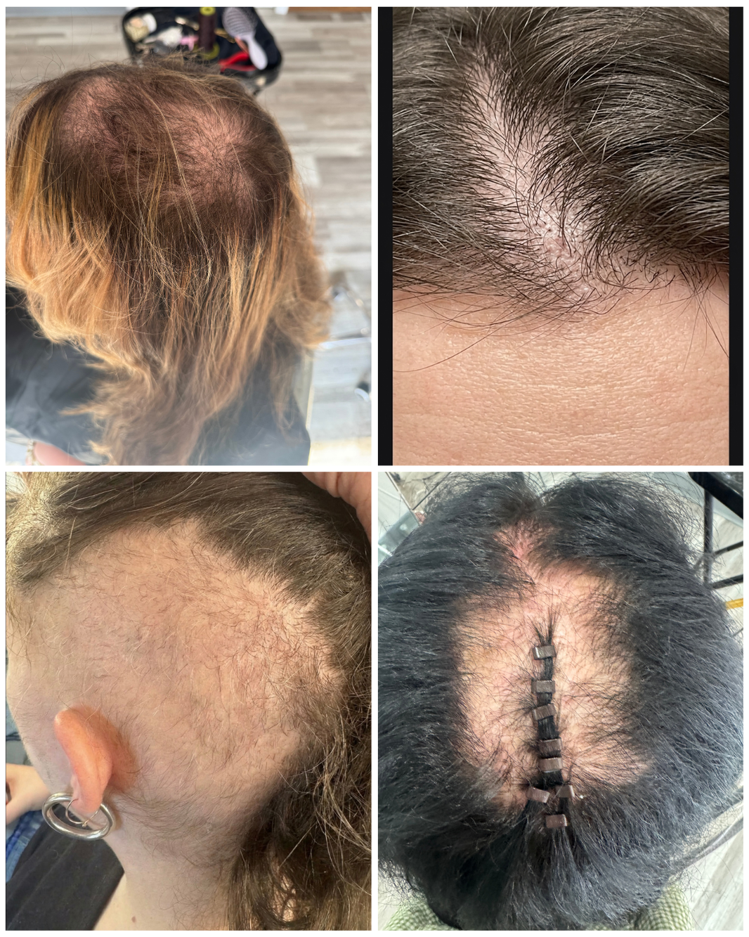 Common trichotillomania hair pulling locations including crown, cowlick, and frontal scalp areas.