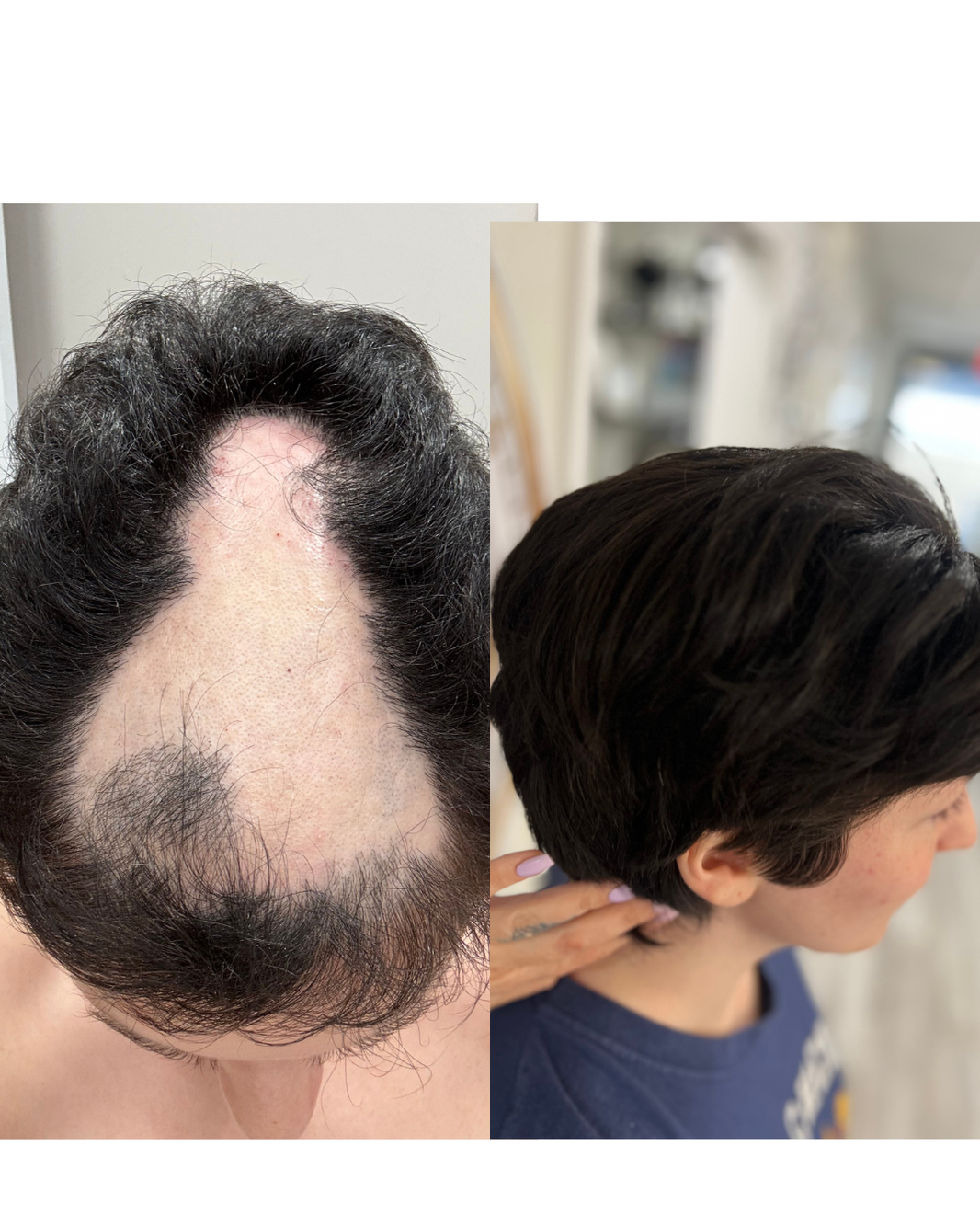 Alopecia areata hair topper transformation