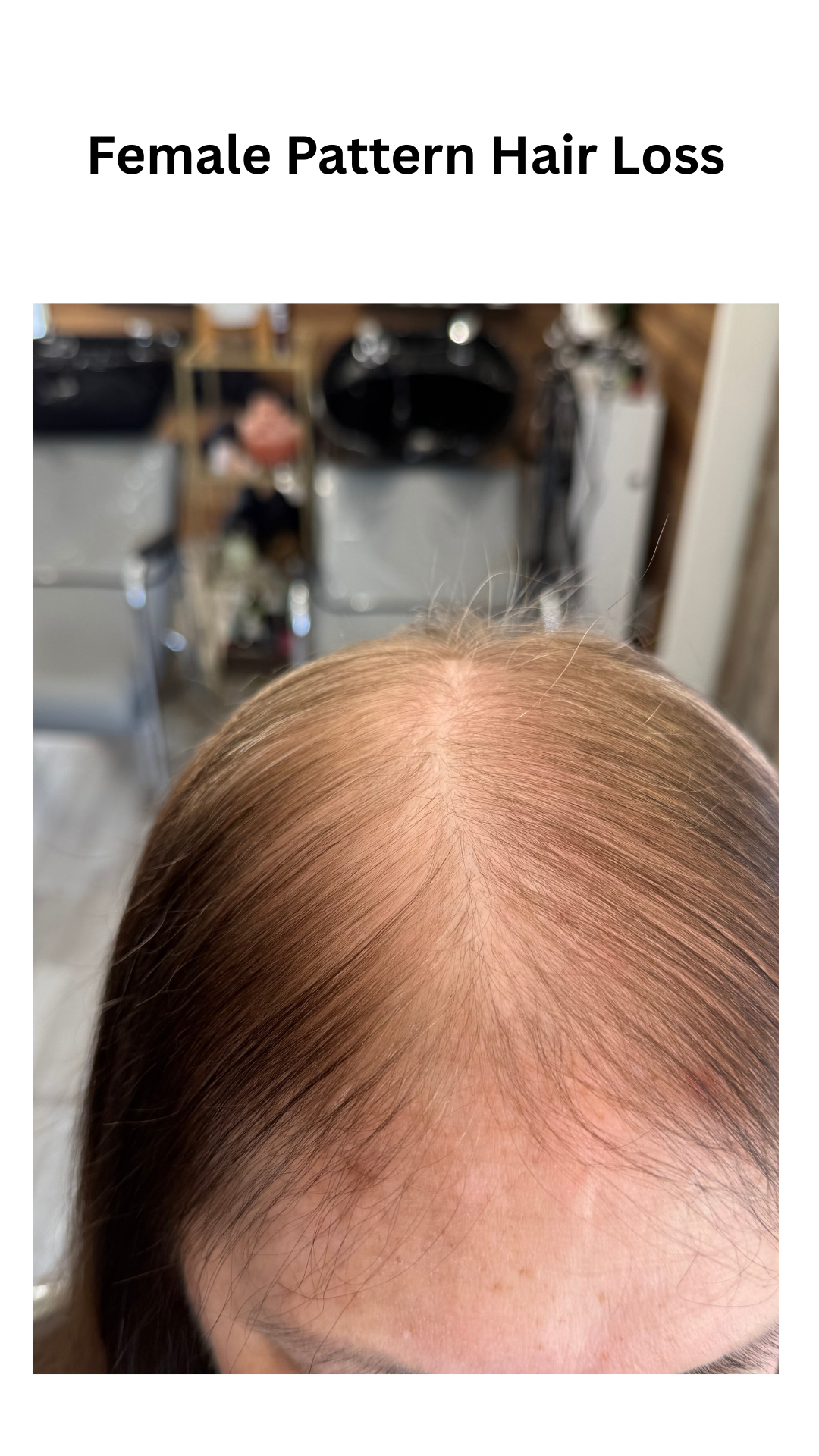 Female pattern hair loss showing widening part and scalp visibility in a woman experiencing thinning hair in Boston.