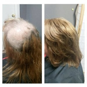 Lichen Planopilaris Hair Loss Help