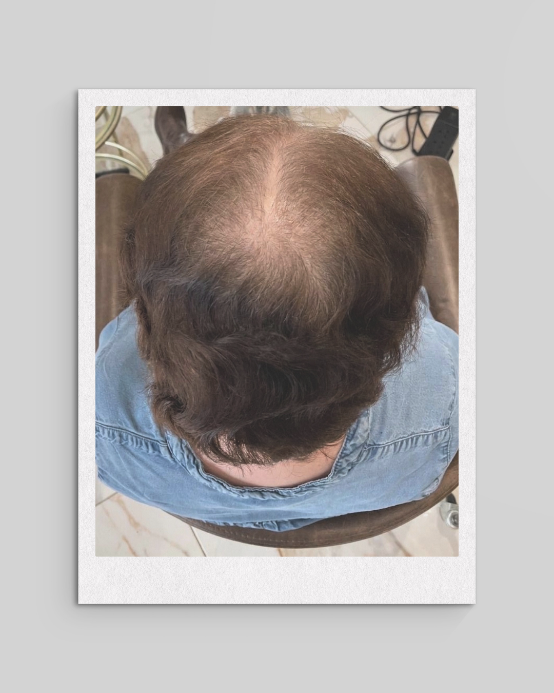 Advanced female pattern hair loss with significant crown thinning, widening part, and visible scalp exposure viewed from above.