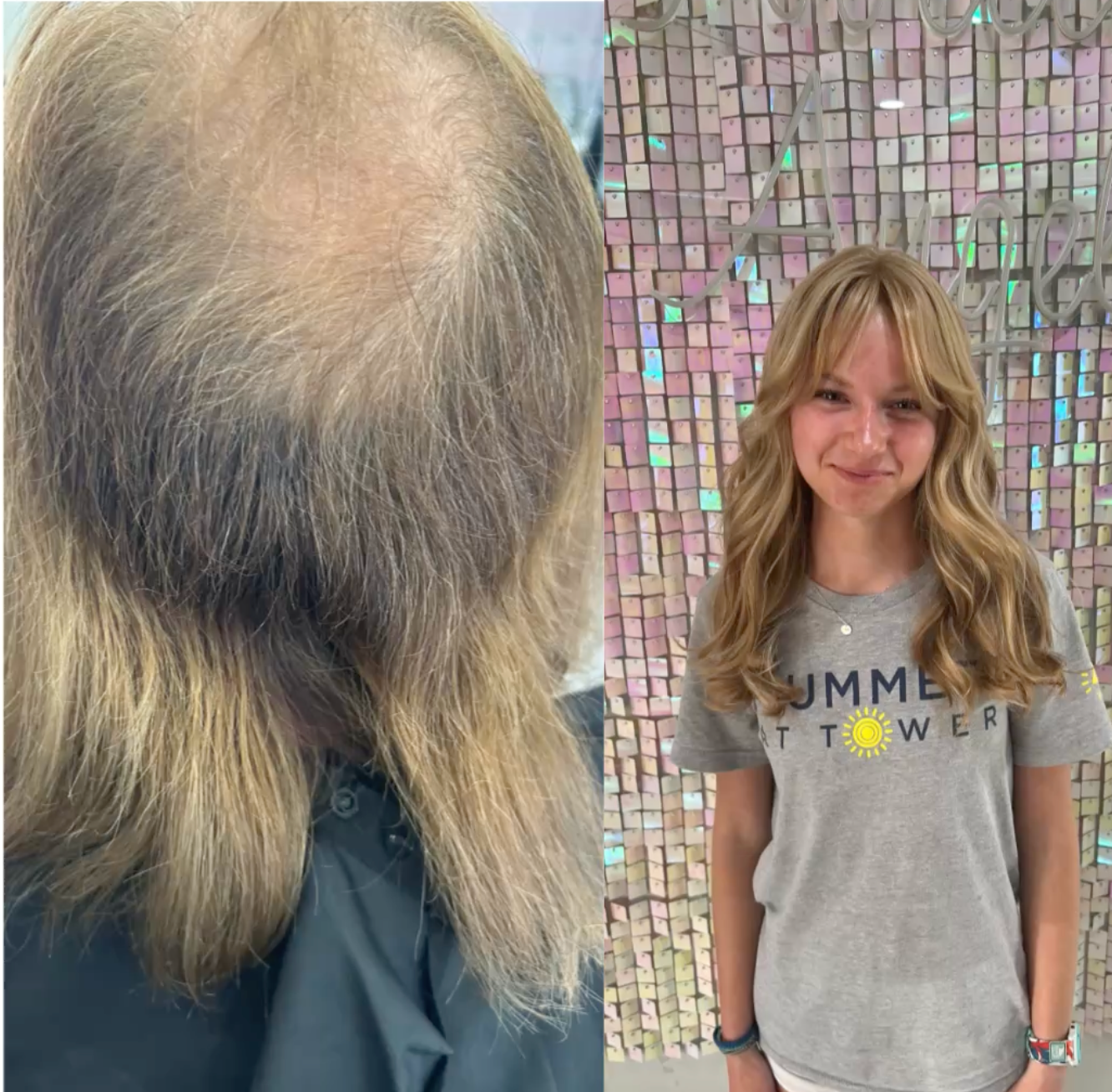 Hair loss transformation showing customized non-surgical hair replacement solution for severe female thinning hair.