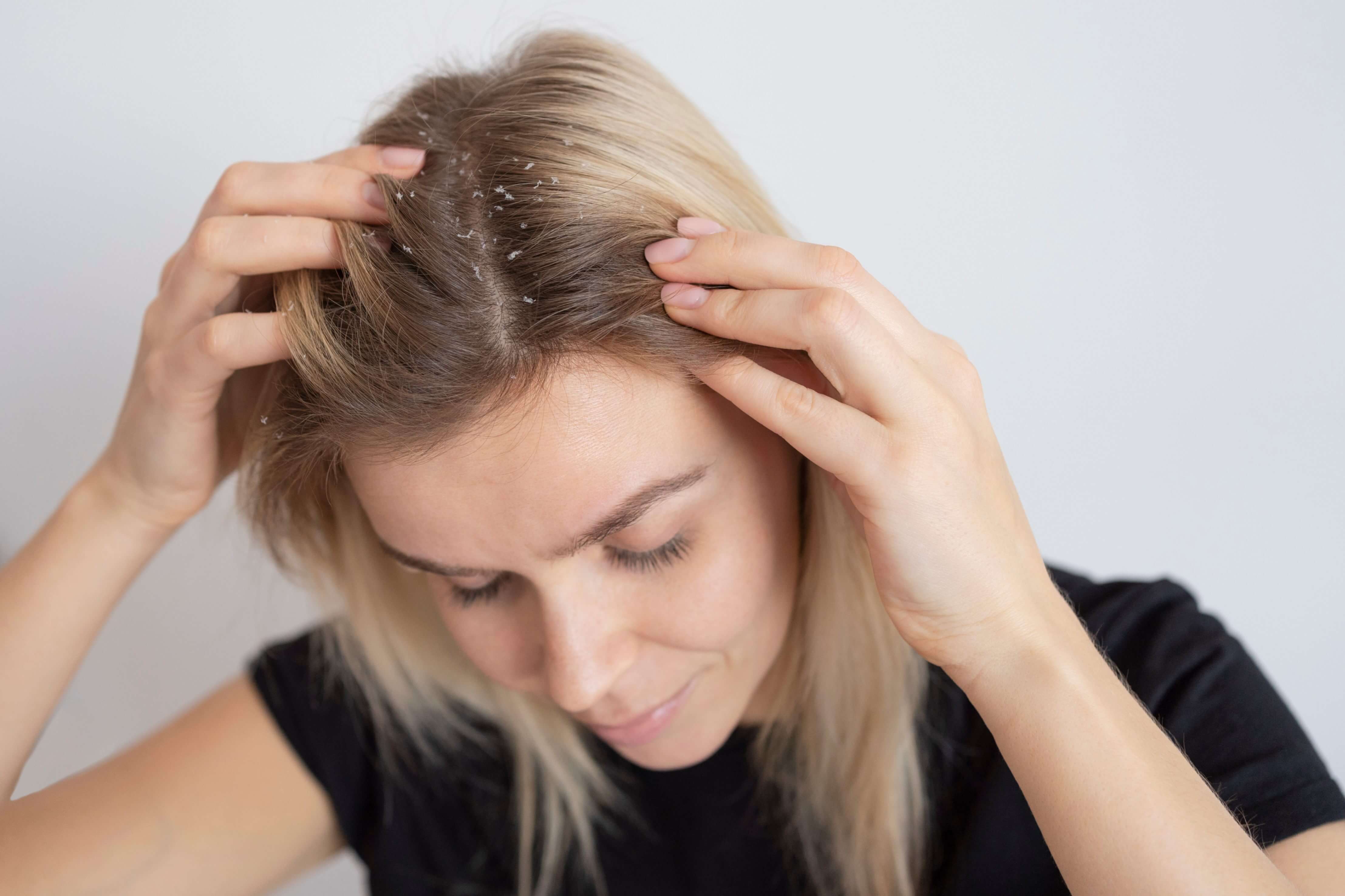 Close-up of woman with dandruff issues scratching scalp